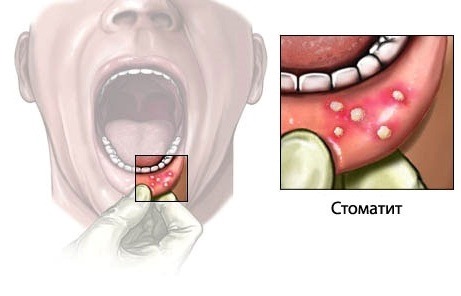 Симптомы и лечение стоматита у детей народными средствами, препаратами, диета