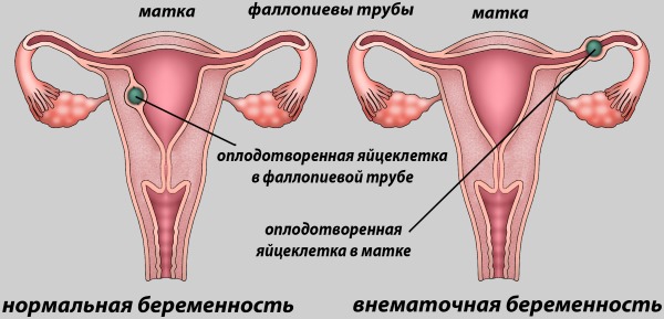 Внематочная беременность – признаки, как определить на ранних сроках, причины и операция по удалению, последствия