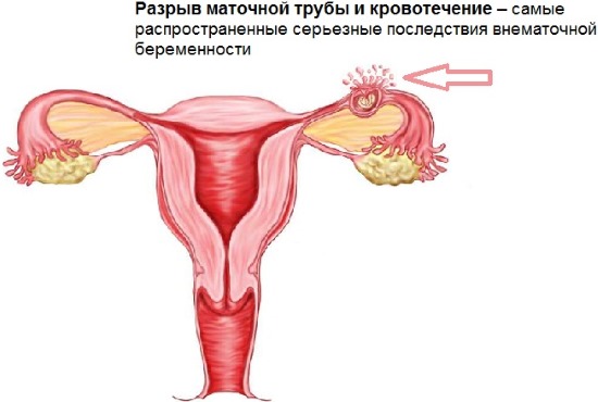 Внематочная беременность – признаки, как определить на ранних сроках, причины и операция по удалению, последствия