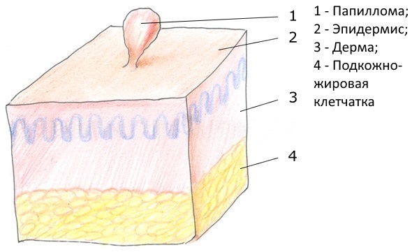 чем удалить папиллому на коже thumbnail