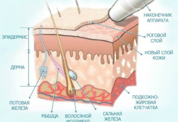 Лечение акне и постакне на лице: аппаратная косметология, препараты, лазером, жидким азотом, холодной плазмой, плазмолифтингом, кремами, гомеопатией, пиявками