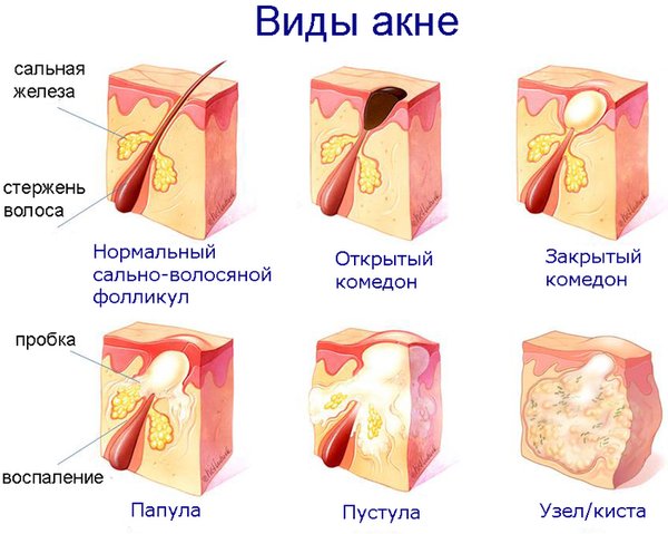 Лечение акне и постакне на лице: аппаратная косметология, препараты, лазером, жидким азотом, холодной плазмой, плазмолифтингом, кремами, гомеопатией, пиявками