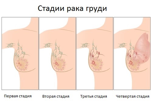 Мастопатия молочной железы - что это такое, причины, симптомы и признаки, последствия. Лечение народными средствами и препаратами