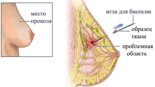 Мастопатия молочной железы - что это такое, причины, симптомы и признаки, последствия. Лечение народными средствами и препаратами