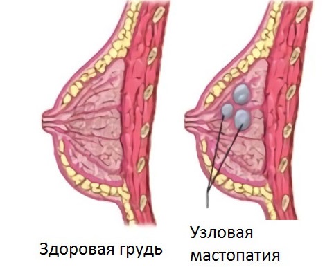 Мастопатия молочной железы - что это такое, причины, симптомы и признаки, последствия. Лечение народными средствами и препаратами