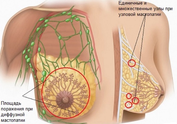 Мастопатия молочной железы - что это такое, причины, симптомы и признаки, последствия. Лечение народными средствами и препаратами