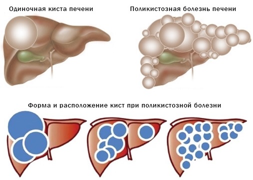 Народные средства для восстановления печени после химиотерапии, антибиотиков, алкоголя. Рецепты лечения печени, желчного пузыря, поджелудочной железы, почек, желудка