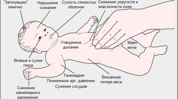 Обезвоживание организма у ребенка: симптомы, причины и последствия. Что делать при рвоте, поносе, лечение детей до года и после