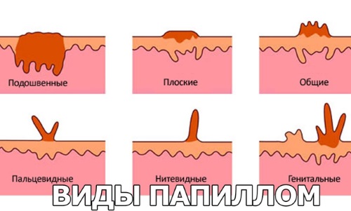 Как избавиться от папилломы на шее в домашних условиях. Народные средства, чистотел, хозяйственное мыло, касторовое масло, препараты из аптеки