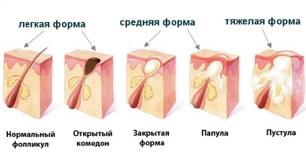 Сыпь на теле у взрослого. Что это может быть, если чешется, мелкая в виде прыщиков, крупная с покраснениями. Фото и как лечить