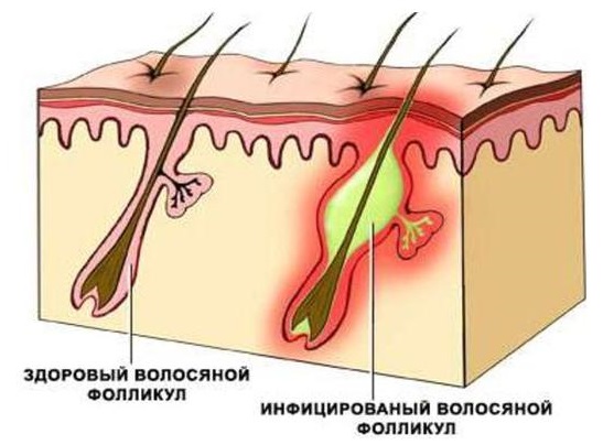 Сыпь на теле у взрослого. Что это может быть, если чешется, мелкая в виде прыщиков, крупная с покраснениями. Фото и как лечить