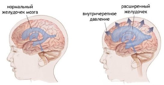 Внутричерепное давление у детей и взрослых. Причины повышенного, пониженного давления, как измерить, симптомы и лечение