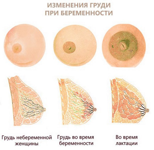 Выделения из грудных желез у женщин при надавливании желтого, белого, зеленого цвета. Причины перед месячными, во время беременности, при климаксе