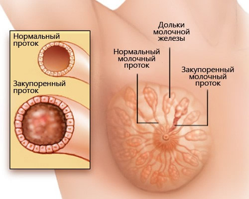 Выделения из грудных желез у женщин при надавливании желтого, белого, зеленого цвета. Причины перед месячными, во время беременности, при климаксе