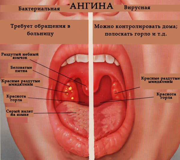 Болезнь Грейвса. Что это, симптомы, лечение