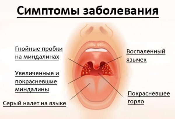 Ангина у детей - симптомы и лечение вирусной, катаральной, бактериальной, гнойной, герпесной формы, с температурой и без. Какой антибиотик принимать, профилактика