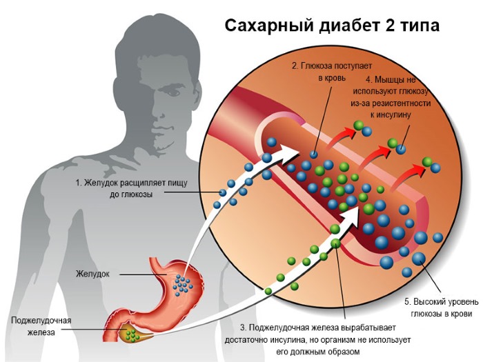 ГСД при беременности. Что это такое, норма сахара, последствия для ребенка, диета