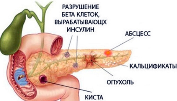 Диета при панкреатите острой и хронической формы. Список продуктов, таблица, при обострении, меню на неделю, рецепты