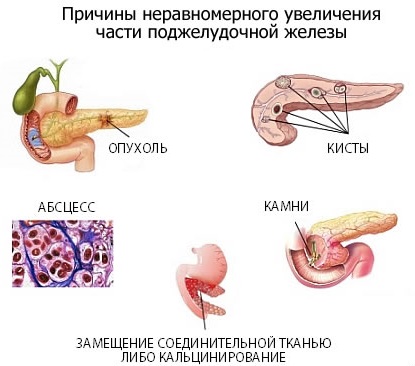 Диффузные изменения поджелудочной железы по типу липоматоза. Что это такое, лечение, диета, народные средства