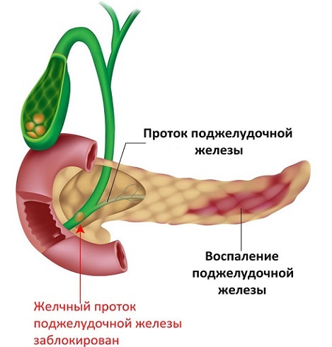 Диффузные изменения поджелудочной железы по типу липоматоза. Что это такое, лечение, диета, народные средства