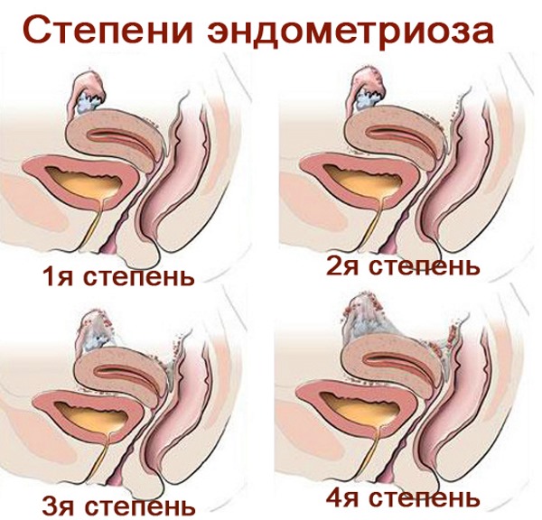 Эндометриоз матки. Симптомы и лечение народными средствами, прогноз