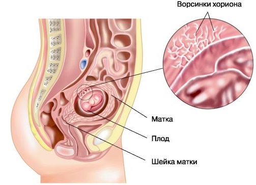 Гематома при беременности на ранних сроках: ретрохориальная в матке, заоболочечная, как выглядит, рассасывается, выходит, выделения. Причины, лечение, советы с форумов