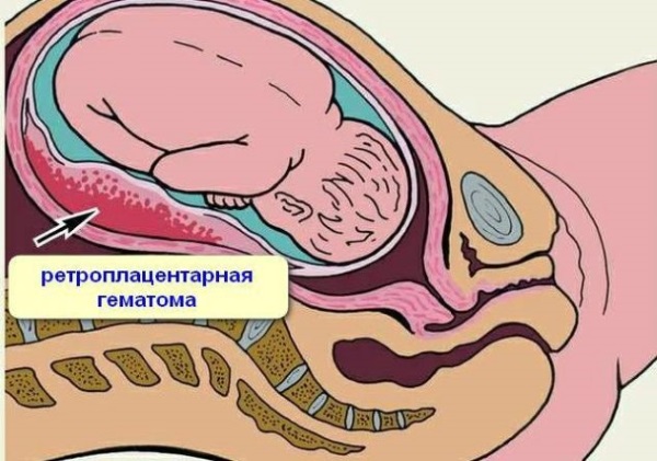 Гематома при беременности на ранних сроках: ретрохориальная в матке, заоболочечная, как выглядит, рассасывается, выходит, выделения. Причины, лечение, советы с форумов