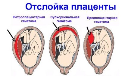 Гематома при беременности на ранних сроках: ретрохориальная в матке, заоболочечная, как выглядит, рассасывается, выходит, выделения. Причины, лечение, советы с форумов