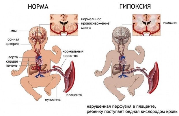 Гематома при беременности на ранних сроках: ретрохориальная в матке, заоболочечная, как выглядит, рассасывается, выходит, выделения. Причины, лечение, советы с форумов