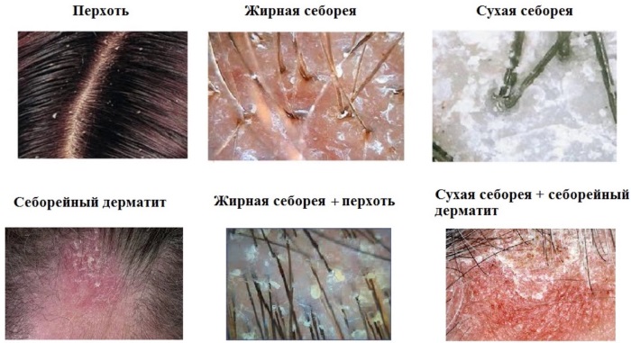 Как избавиться от перхоти на голове быстро и эффективно: народными средствами, препараты, перекисью водорода, солью, содой, лечебные шампуни