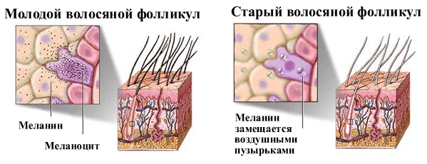 Как избавиться от седины без окрашивания, краски, народные средства, оттеночные шампуни. Причины ранней седины у мужчин и женщин