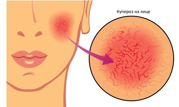 Купероз на лице: фото, причины и лечение, как убрать в домашних условиях. Препараты, кремы, мази в косметологии