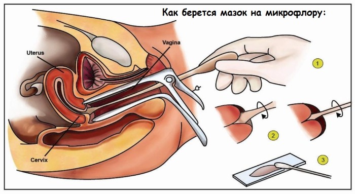 Кокки в мазке у женщин: что это, положительные, единичные, полиморфные, причины, лечение. Если обнаружены при беременности