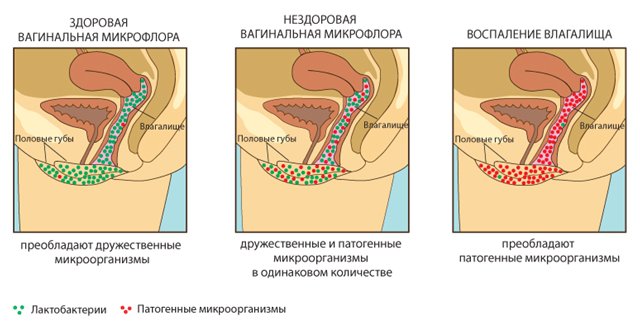 Кокки в мазке у женщин: что это, положительные, единичные, полиморфные, причины, лечение. Если обнаружены при беременности