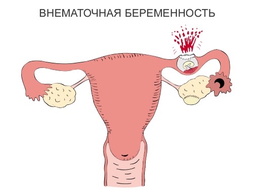 Коричневые выделения без боли и запаха у женщин. Что это, причины и лечение