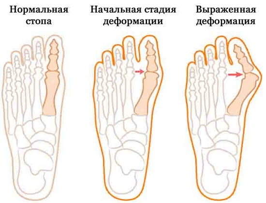 Кость на ноге возле большого пальца. Причины и лечение в домашних условиях. Народные средства, препараты, операция