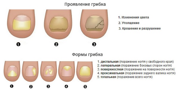 Микодерил – средство от грибка ногтей. Инструкция по применению, цена, отзывы, аналоги