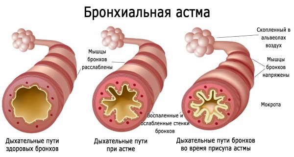 Одышка и нехватка воздуха: причины при беременности, у ребенка, пожилого человека, при ходьбе, физических нагрузках и в спокойном состоянии