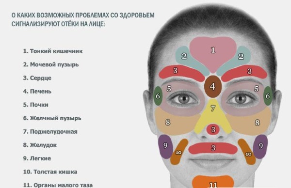 Отек лица. Причины у женщин по утрам, перед месячными, при гормональном сбое, нарушении эндокринной системы. Анализы и лечение