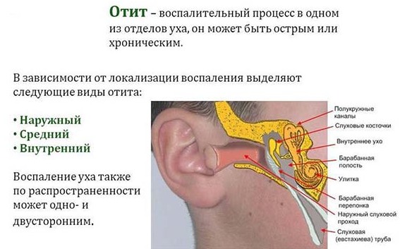 Отит у ребенка - симптомы и лечение в домашних условиях. Препараты, народные средства, лечение по Комаровскому