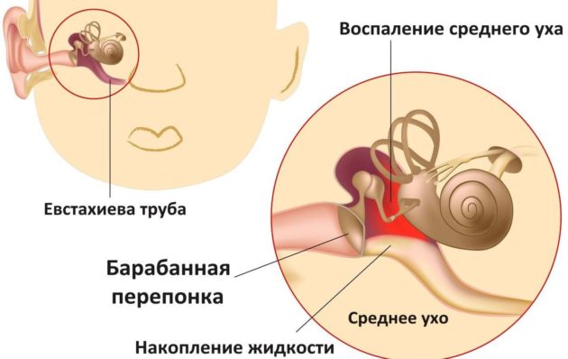 Отит у ребенка - симптомы и лечение в домашних условиях. Препараты, народные средства, лечение по Комаровскому