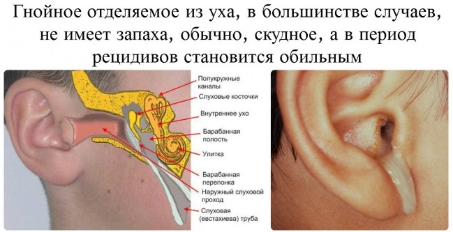 Отит у ребенка - симптомы и лечение в домашних условиях. Препараты, народные средства, лечение по Комаровскому