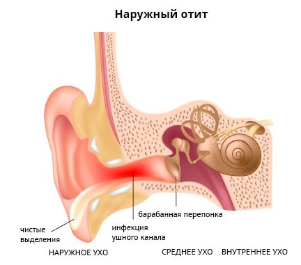 Отит у ребенка - симптомы и лечение в домашних условиях. Препараты, народные средства, лечение по Комаровскому