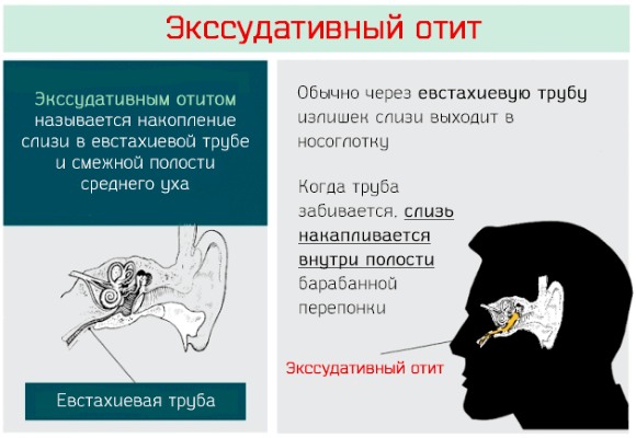 Отит у ребенка - симптомы и лечение в домашних условиях. Препараты, народные средства, лечение по Комаровскому