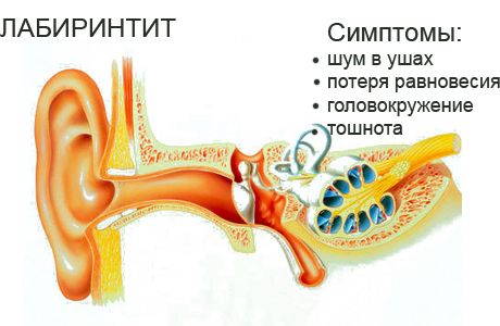 Отит у ребенка - симптомы и лечение в домашних условиях. Препараты, народные средства, лечение по Комаровскому