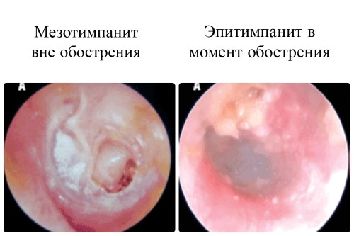 Отит у ребенка - симптомы и лечение в домашних условиях. Препараты, народные средства, лечение по Комаровскому