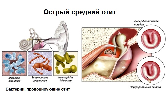 Отит у ребенка - симптомы и лечение в домашних условиях. Препараты, народные средства, лечение по Комаровскому