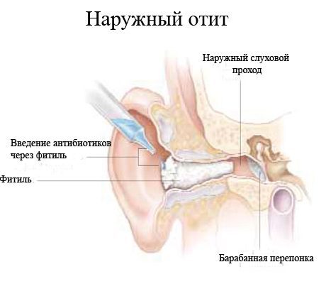 Отит у ребенка - симптомы и лечение в домашних условиях. Препараты, народные средства, лечение по Комаровскому