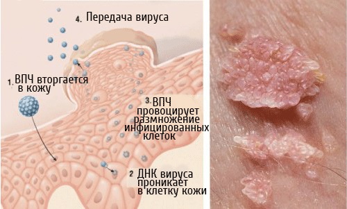 Причины бородавок на руках, лечение салициловой кислотой, чистотелом, чесноком, картошкой, мазями, касторовым маслом