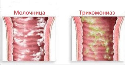 Признаки молочницы у женщин, симптомы. Как выглядит, причины возникновения. Лечение народными средствами и препаратами